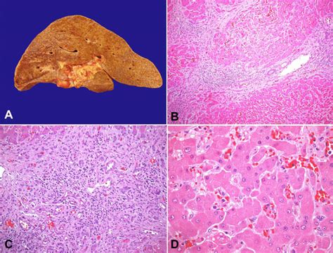 Liver Cirrhosis Biopsy