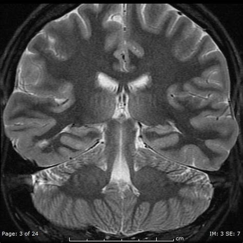 Classification System For Malformations Of Cortical Development Radiology Reference Article