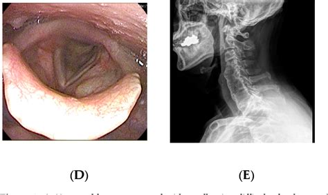 Figure 1 From Surgical Treatment Of Dysphagia Secondary To Anterior Cervical Osteophytes Due To