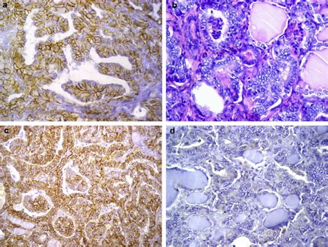 A Classic Papillary Thyroid Carcinoma Showing Strong Diffuse