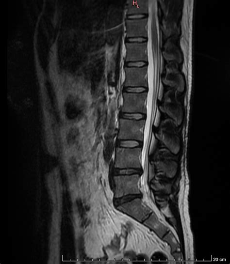 L5 nerve root compression caused by facets, protrusion or both? : r/Sciatica