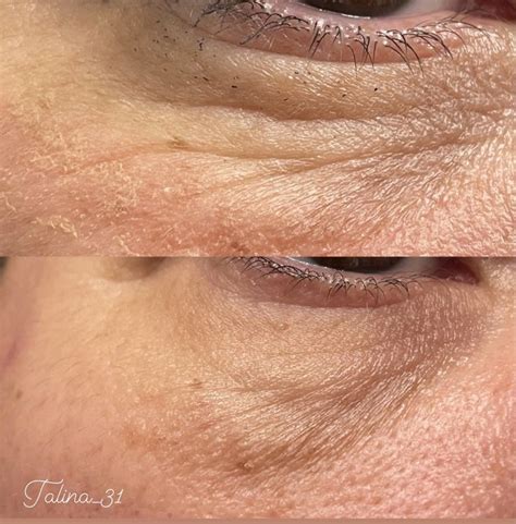 Microneedling Before After Eyebrow Shaping Beauty Microneedling