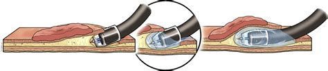 Saline Pocket Endoscopic Submucosal Dissection For Superficial Colorectal Neoplasms A