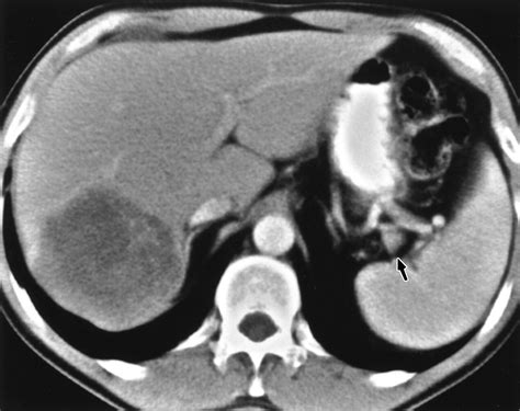 Ct Features Of The Accessory Spleen Ajr