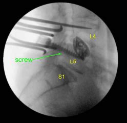 L Bilateral Laminectomies Complete Orthopedics Ny