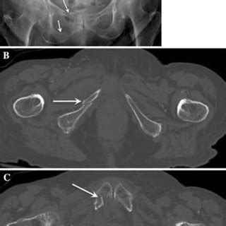 Ffp Type A A Year Old Woman With Right Hip Pain After Fall Ap