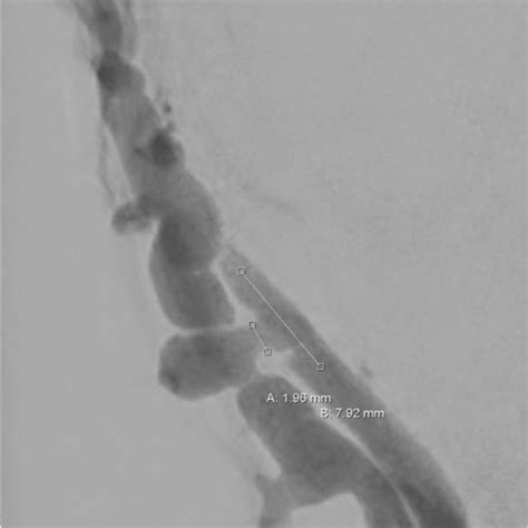 Diagnostic angiogram demonstrates the Arteriovenous fistula (AVF) of ...