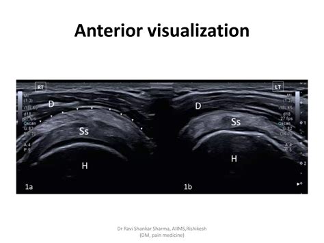 Diagnostic Ultrasound Of Shoulder Ppt