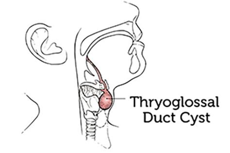 Thyroglossal Cyst New