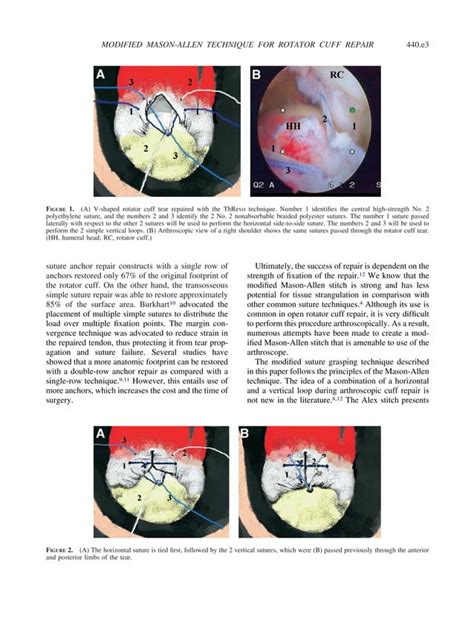 Castagna 2007 Arthroscopic Rotator Cuff Repair Using A Triple Loaded