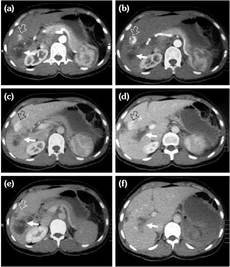 On Contrast Enhanced Computed Tomography Images [arterial Phase A B