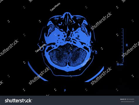 Imaging Brain On Xray Mri Mra Stock Photo Shutterstock