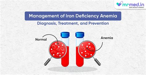 Management of Iron Deficiency Anemia: Diagnosis, Treatment, and Prevention