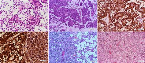 Pancreas Cysts Pancreatic Cancer Johns Hopkins Pathology