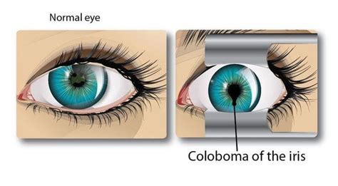 Coloboma: The Unusual Pupil | All About Eyes