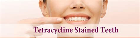 Tetracycline stained teeth: Harm, Causes and Treatment