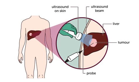 Ablation - Liver Cancer UK