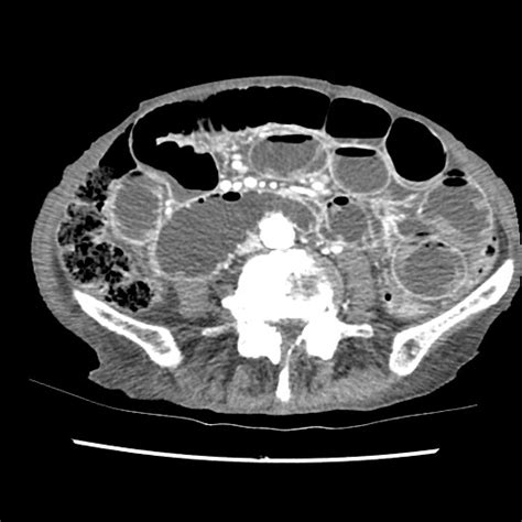 Obturator Hernia Causing Small Bowel Obstruction Image