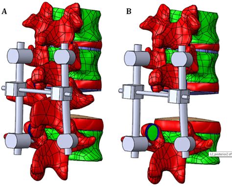 Posterior Transpedicular Stabilization On A Corpectomy A And