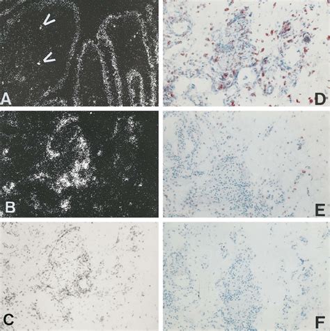 IL 10 MRNA Expression In IBD A Only A Few MNCs In The Inflamed Mucosa