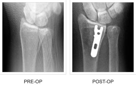 Volar Hook Plate Wrist Fracture Fixation Plate Trimed Inc