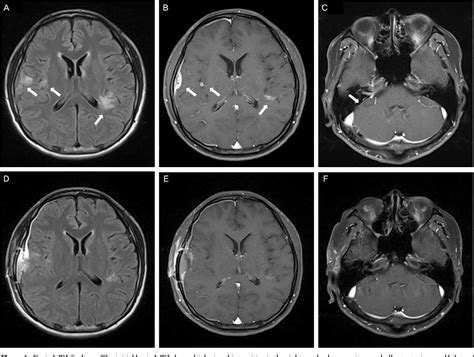 Figure From Neurosyphilis Presenting With Multiple Cranial Neuropathy