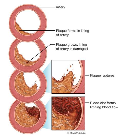 Isquemia Miocárdica Síntomas Y Causas Mayo Clinic