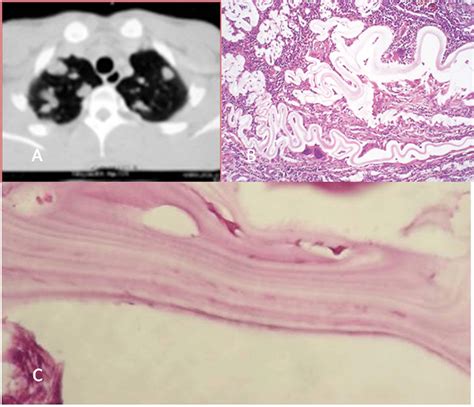 A Chest Ct Scan Mediastinal Cyst Evoking A Hydatid Cyst In The Left