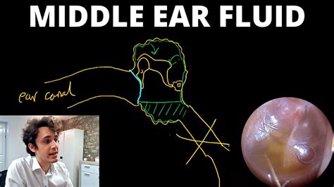 Why Does Fluid Build Up Behind The Eardrum Otitis Media With Effusion