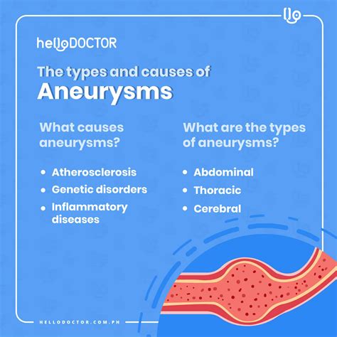 Aneurysm Types and Causes - What You Need to Know - Hello Doctor