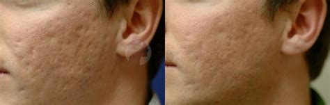 Fraxel Skin Resurfacing Dallas Center For Dermatology And Aesthetics