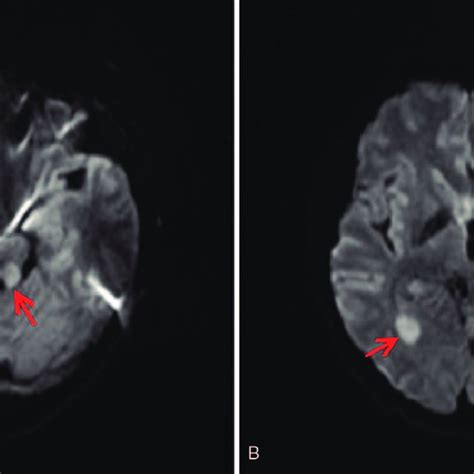 Brain Diffusion Weighted Magnetic Resonance Imaging Mri Dwi Of The Download Scientific