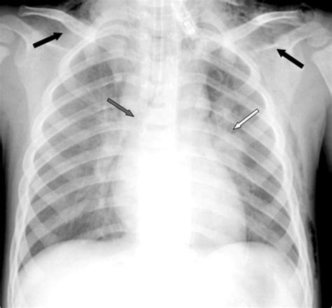 Chest X Ray Showing A Significant Enlargement Of The Left Lung Hilum Download Scientific