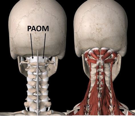 Chiari malformation treatment