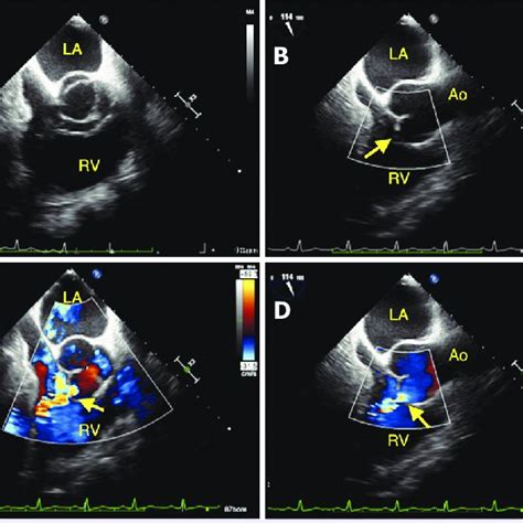 A Transesophageal Echocardiography Tee Mid Esophageal Short Axis