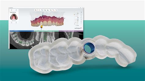 How And Why To Use Guided Implant Surgery Glidewell