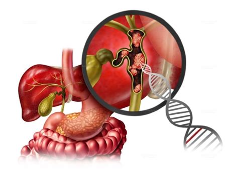 Bile Duct Cancer Treatment With Targeted Therapy