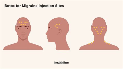 Botox Migraine Injection Site Diagram Botox For Migraine Is