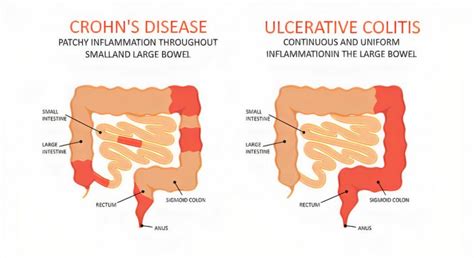 Ulcerative Colitis (UC): Causes, Symptoms, Types, Diagnosis & Treatment ...