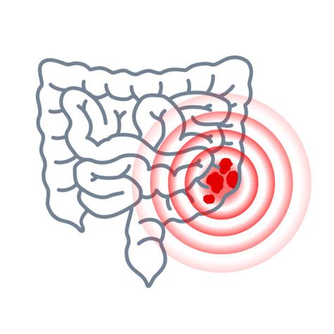 Colonoscopy Infographic Stock Vectors Istock