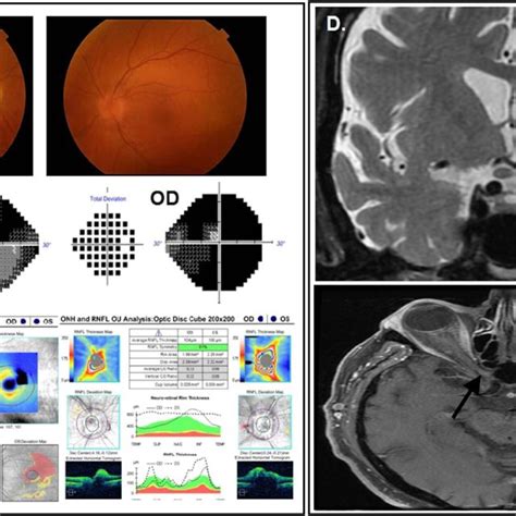 Case On Presentation A Fundus Photography Reveals Bilateral Optic