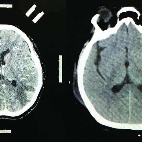 Neurosyphilis Forms Of Presentation Download Scientific Diagram