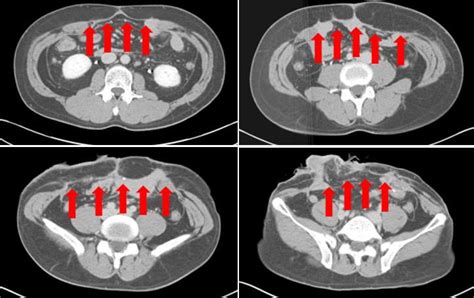 Abdominal Computed Tomography Shows An Approximately Cm Fascial