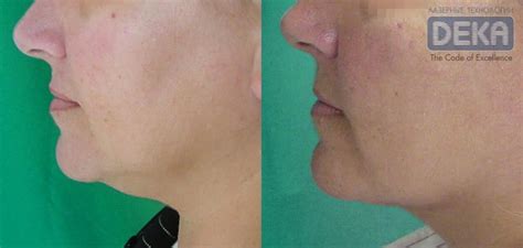 Липолиз лазерний, як засіб проти небажаних жирових відкладень