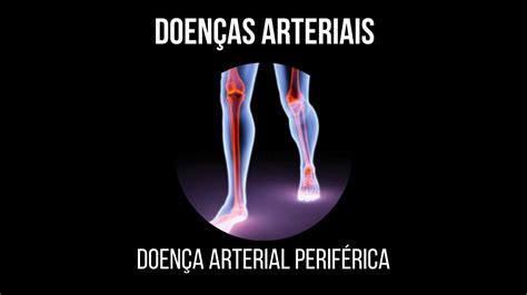 Doença Arterial Periférica Claudicação Youtube