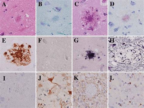 Kuru Plaques By Various Staining Methods Amyloid Deposits With