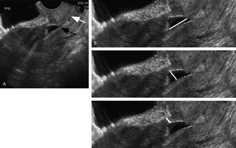 Cesarean Scar Defect Longitudinal Tvs A Shows A Triangular Defect In Download Scientific