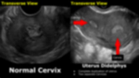 SOLUTION: Congenital uterine abnormalities ultrasound - Studypool