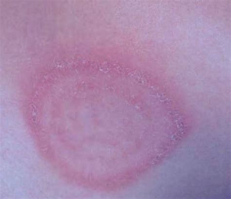 Ringworm – Images, Causes, Symptoms, Treatment | HubPages