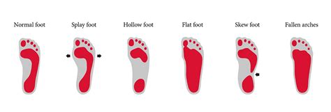 The Most Common Foot Ailments Explained